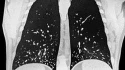 Histoplazmoza (choroba Darlinga) - objawy, przyczyny, leczenie