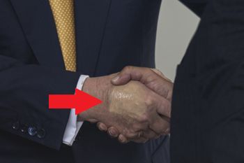 Zauważyli plamę na dłoni Trumpa. "Lekarze próbują ukryć siniaki"