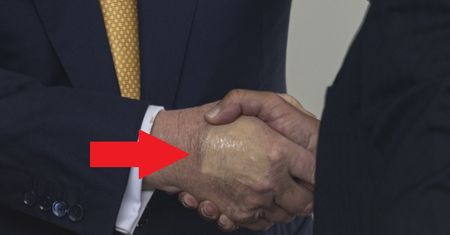 Zauważyli plamę na dłoni Trumpa. "Lekarze próbują ukryć siniaki"