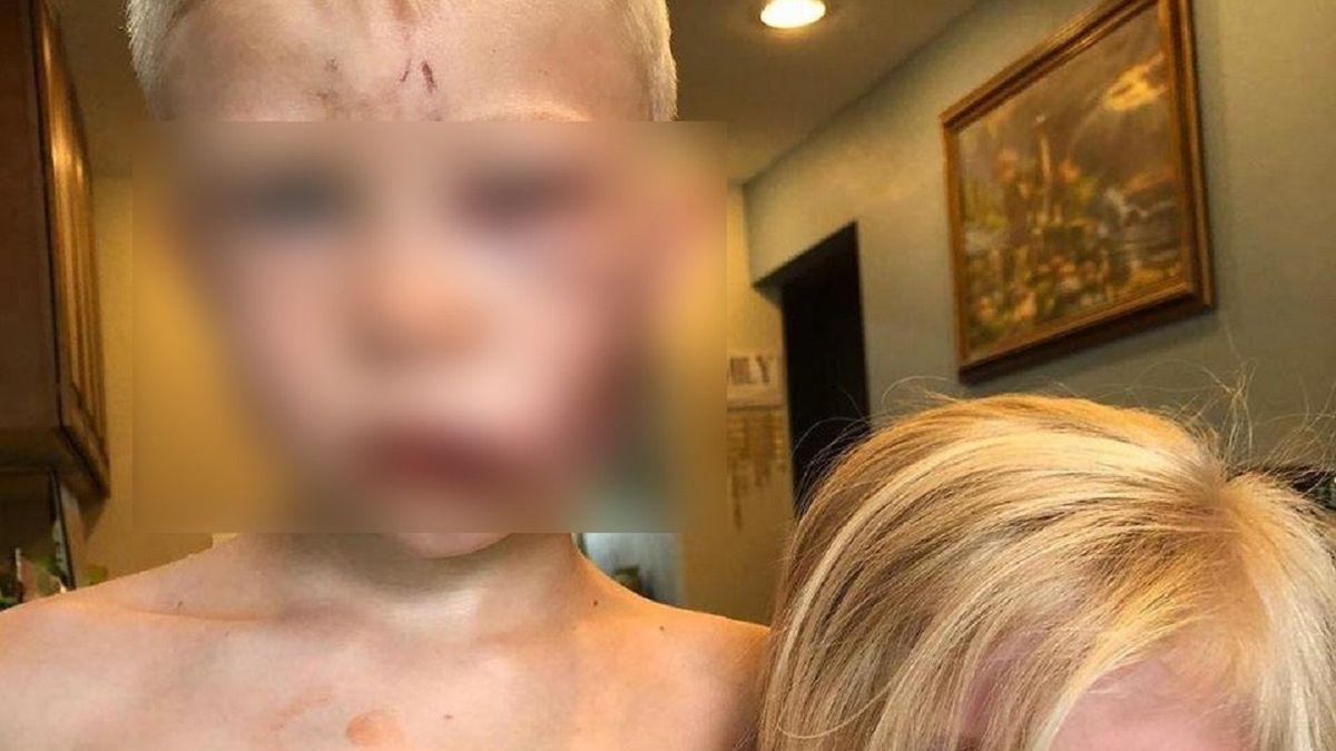 6-latek uratował swoją siostrę. Przyjął atak psa na siebie. 