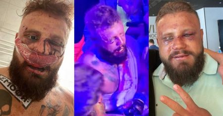 Arnold Jabłoński pokazuje POOBIJANĄ twarz po walce z uczestnikiem "Hotelu Paradise" (ZDJĘCIA)