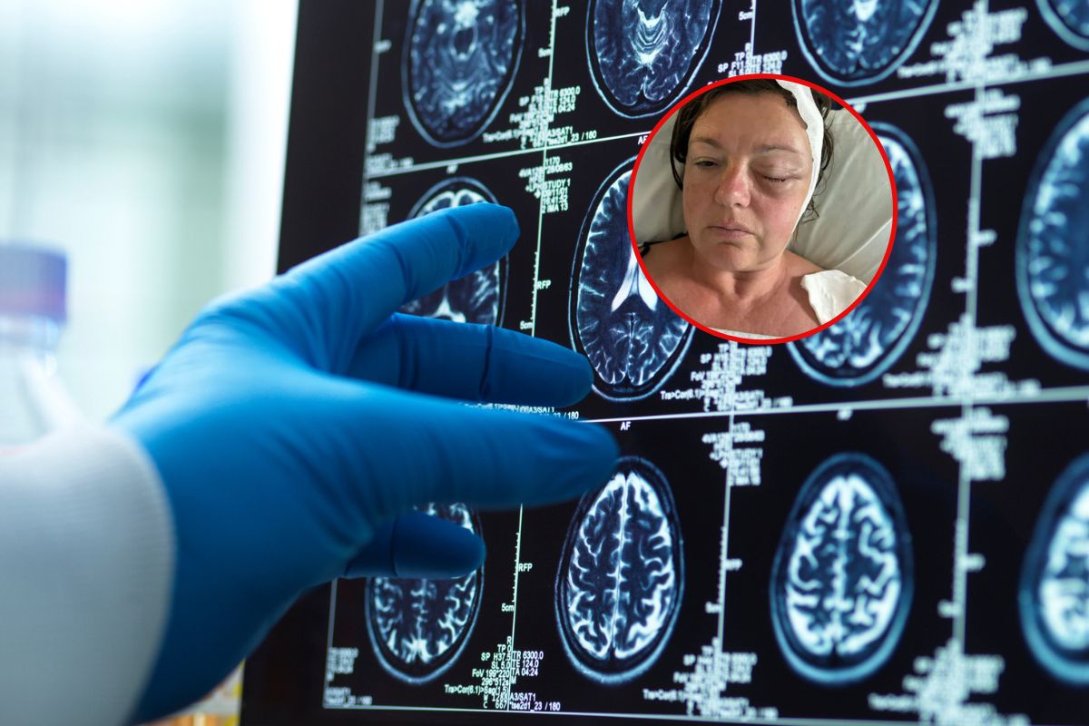 Myślała, że pogarsza się jej wzrok. Tak objawiał się guz mózgu