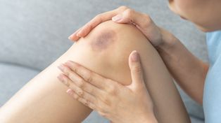 Masz dużo siniaków? Przyczyną może być niedobór ważnego składnika