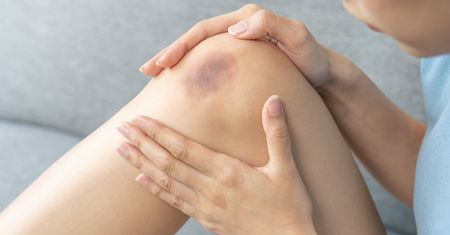 Masz dużo siniaków? Przyczyną może być niedobór ważnego składnika