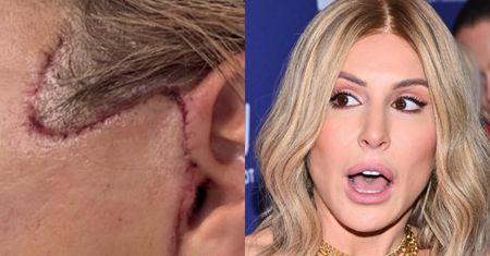 Blanka Lipińska pokazuje BLIZNY po liftingu twarzy: "Profesor mówi, że śladów po nich nie będzie..."