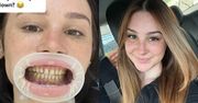 Wydała tysiące na "tureckie zęby". Tak wygląda po metamorfozie uśmiechu. Nie wszyscy są przekonani: "NIE BYŁO WARTO"