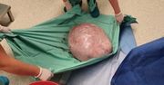 To kolejny tak ogromny guz jajnika, który wycięto. Ważył 17 kg