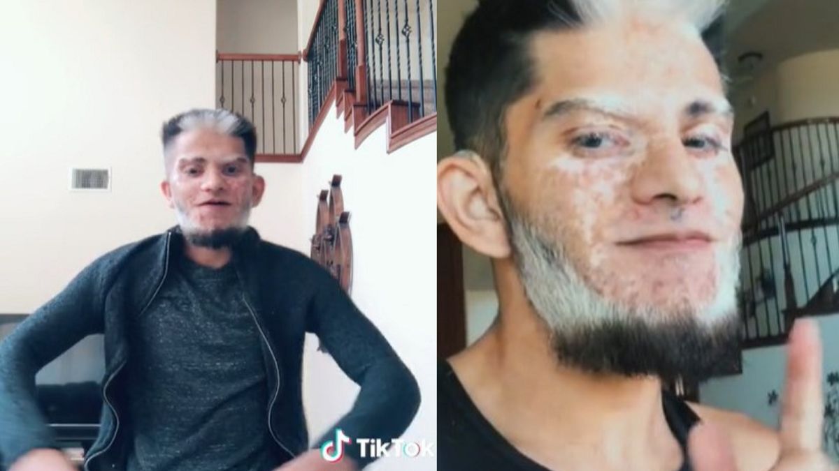 Cierpi na rzadką chorobę. "Ludzie pytają, czy mam 80 lat"