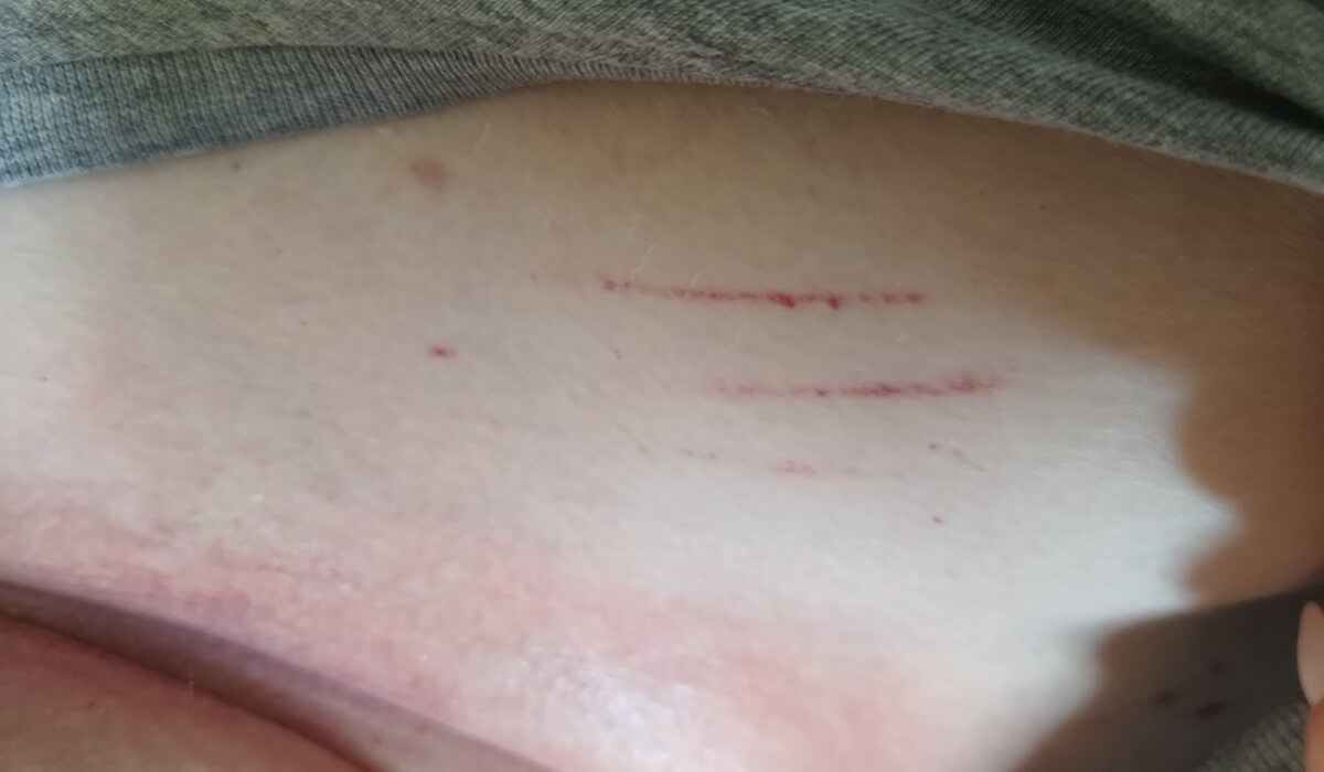 Ślady po paznokciach personelu (mama nie jest w stanie sama tego dokonać, bo ma niedowład kończyn)