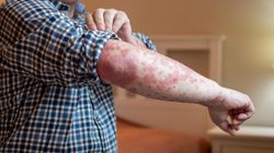 Wysypka rozprzestrzeniła się na połowę jego ciała. Tak wątroba dawała o sobie znać