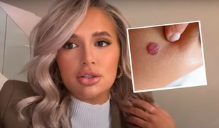 Usunęła pieprzyk i się zaczęło. Gwiazda "Love Island" jest przerażona
