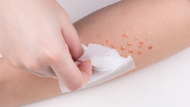 Mięczak zakaźny – po czym go rozpoznać i jak go leczyć