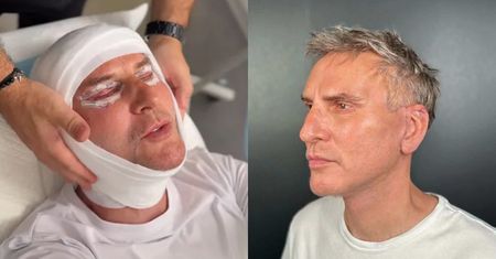 TYLKO NA PUDELKU: Krzysztof Gojdź ZDJĄŁ SZWY i pokazał, jak wygląda jego poliftingowa twarz warta 150 tysięcy złotych
