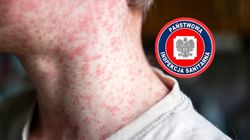 Na Podkarpaciu potwierdzono już 11 przypadków odry. Sanepid rozszerza dochodzenie 