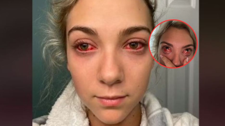 Chciała tylko przedłużyć rzęsy. Po zabiegu nie mogła otworzyć oczu