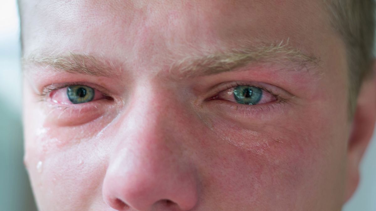 Podkrążone oczy – przyczyny, zagrożenia