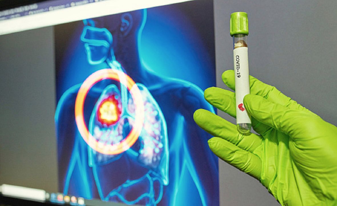 Nawet przechodząc bezobjawowo COVID-19 uszkadza płuca 