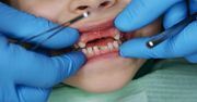 Białe plamki na zębach dziecka? Problem dotyczy nawet co czwartego dziecka w Polsce