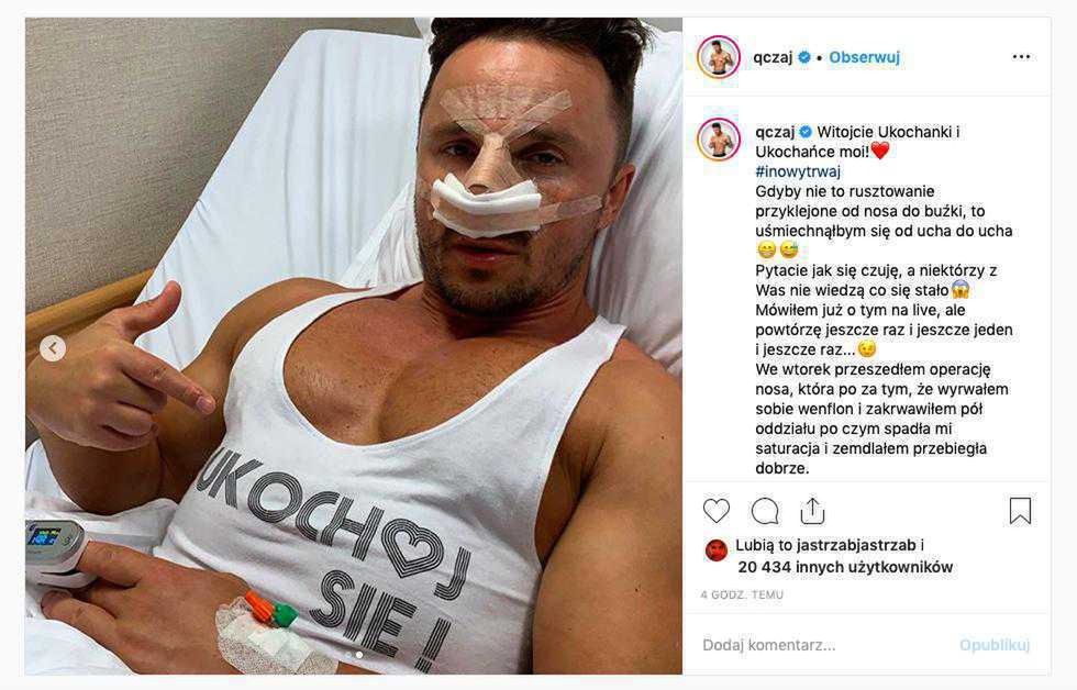 Daniel Qczaj miał operację plastyczną nosa