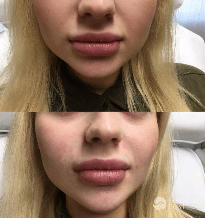 Ewelina z Warsaw Shore poprawiła bruzdy nosowe