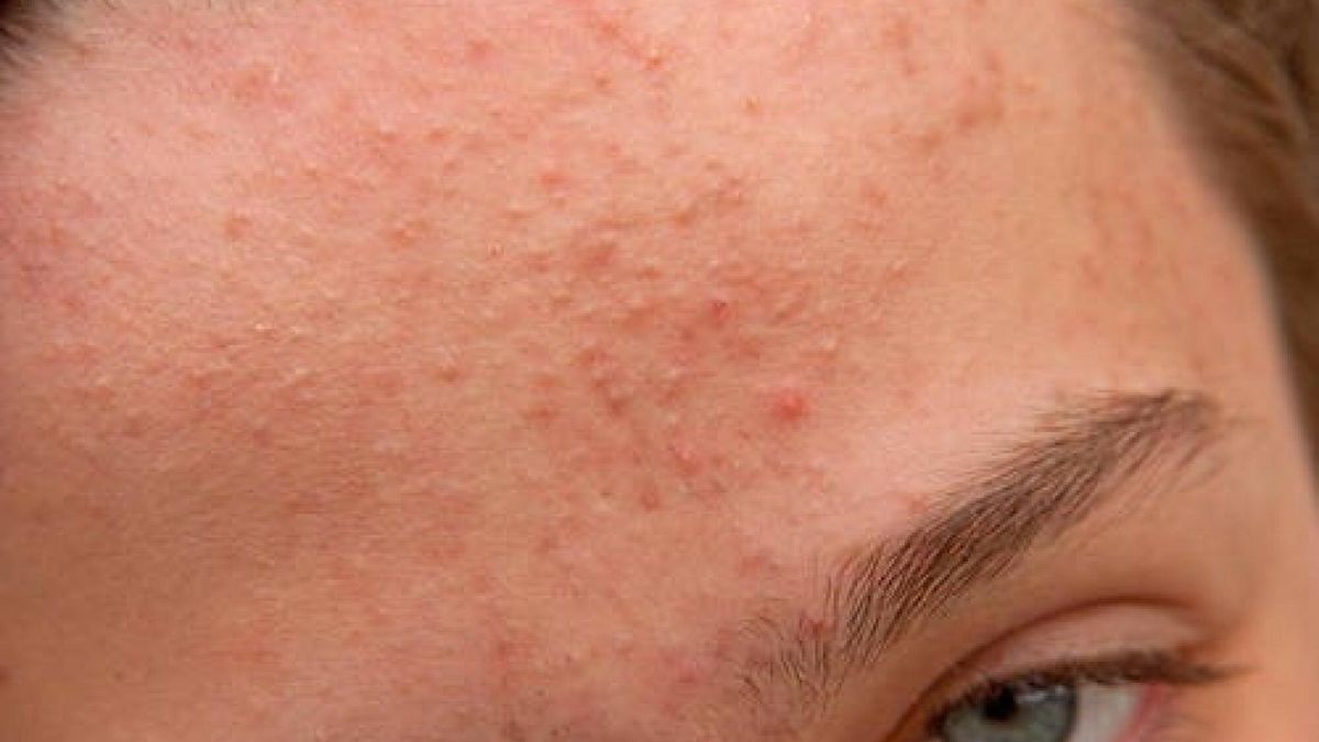 Przewlekły stres i lęk mogą wywołać objawy dermatologiczne. Jakie schorzenia skóry mają podłoże psychiczne?