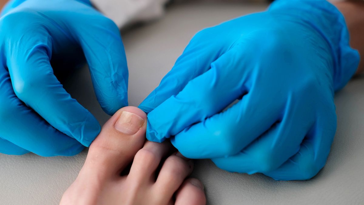 A close-up of a foot with a fungus on the nails is examined by a doctor in gloves. Onycholysis: detachment of the nail from the nail bed.
A close-up of a foot with a fungus on the nails is examined by a doctor in gloves. Onycholysis: detachment of the nail from the nail bed.
Irina Tiumentseva
fungi, inspecting, chiropody, fingernails, nail fungus, diseases