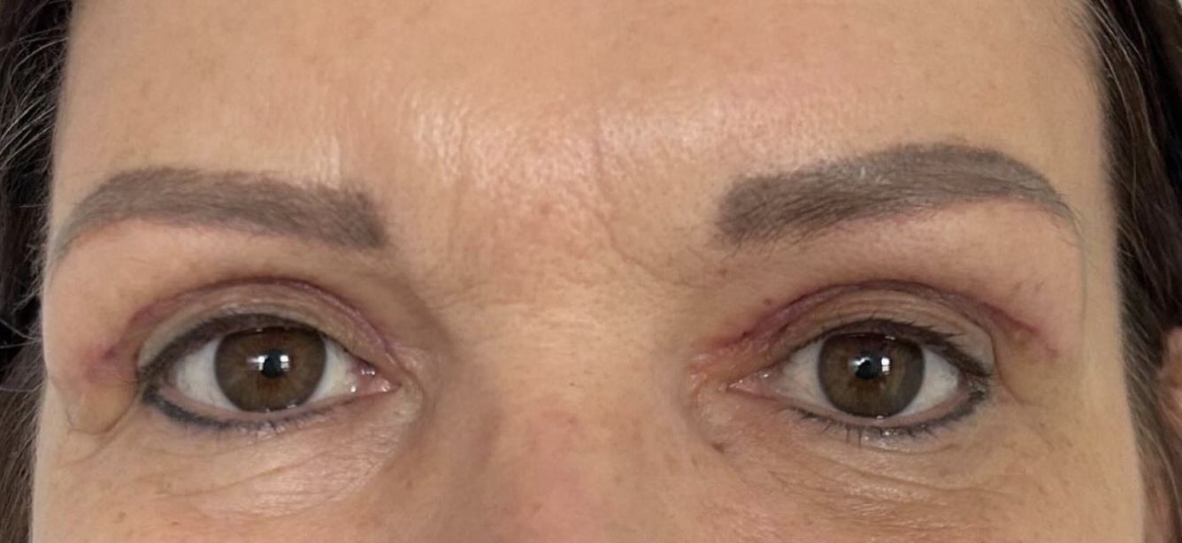 Ilona Felicjańska po zabiegu powiek