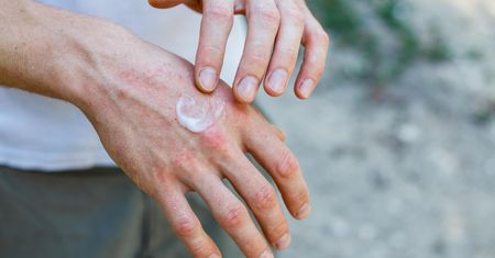 Podrażniona skóra i co dalej? Domowe sposoby na podrażnioną skórę