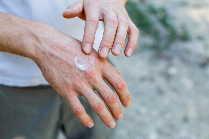 Podrażnienia skóry to częsty problem osób w każdym wieku. 