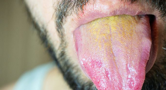 Przebarwienie języka lepiej skonsultować z lekarzem