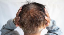 Objaw widoczny na głowie. Może świadczyć o poważnej chorobie jelit