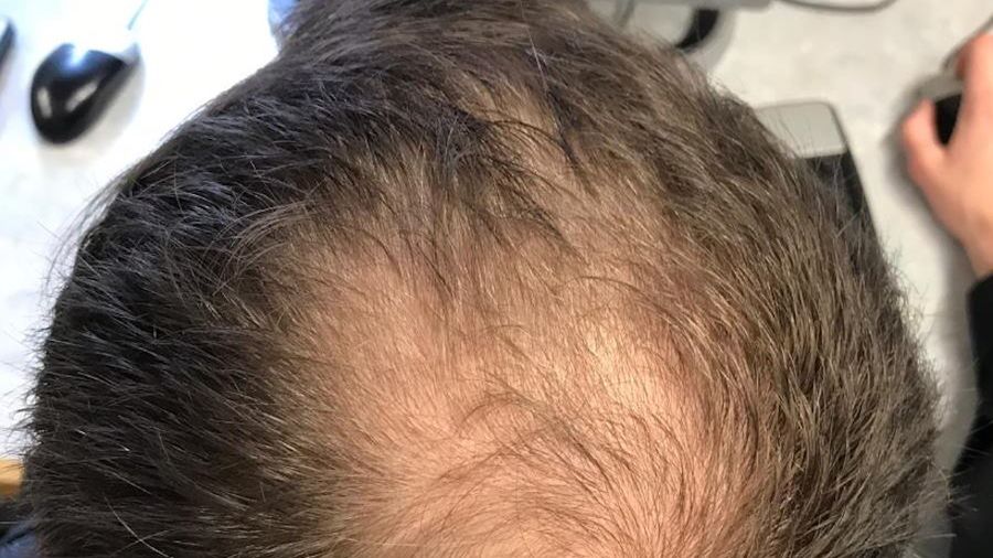 Czy naukowcy mają sposób na odrost włosów?