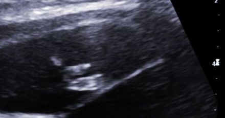 Chcesz aborcję? Najpierw musisz zobaczyć płód