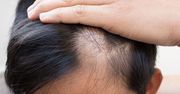 O czym świadczy łysienie u mężczyzn?