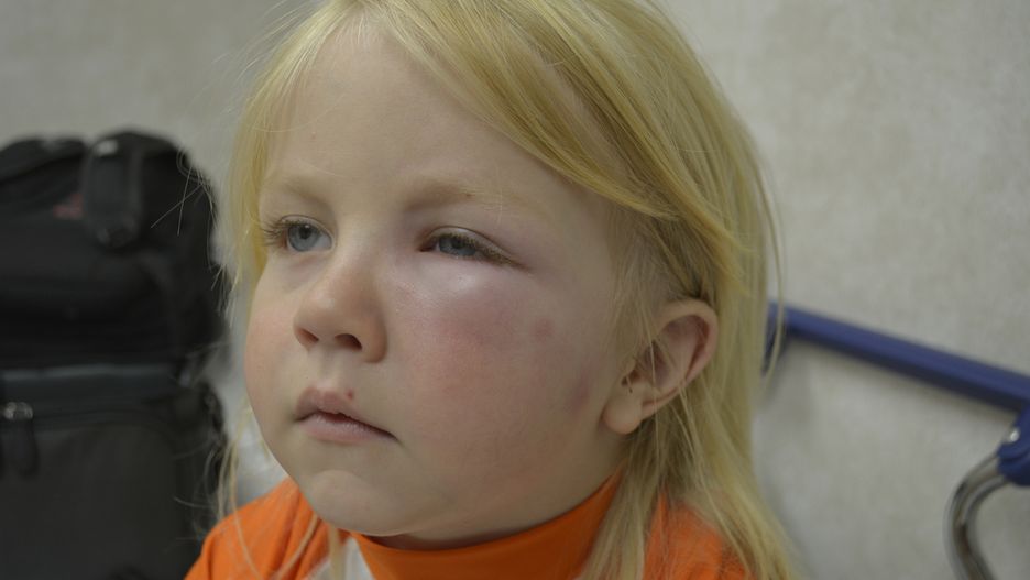 Uczulenie na jad owadów może być bardzo niebezpieczne