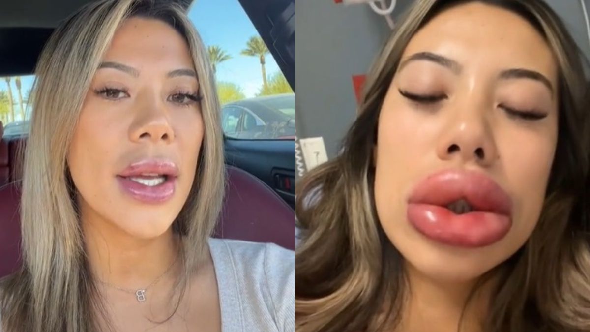 Poszła na zabieg wypełniania. Potem trafiła do szpitala