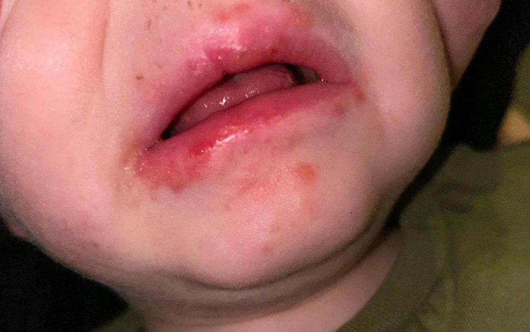 U Davida rozwinęła się wysypka wokół ust
