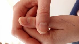 O czym świadczą pionowe prążki na paznokciach? (WIDEO)