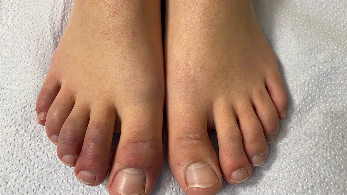 "Covidowe palce" coraz częściej pojawiają się u młodych 