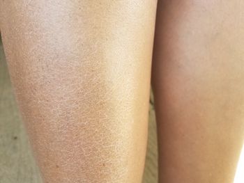 Przesuszona skóra zimą? Oto najlepszy patent z apteki