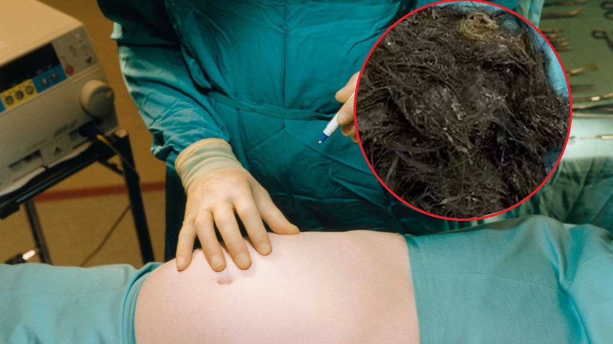Lekarze wyciągnęli 3 kg włosów