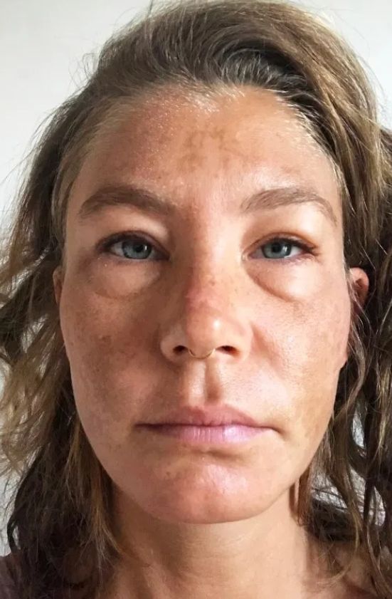 35 - latka twierdzi, że &quot;dieta&quot; pomogła jej pozbyć się problemów skórnych (Instagram)