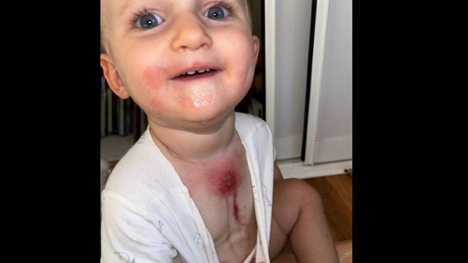 Wykwit na ciele malucha został potraktowany jak alergia, było znacznie gorzej