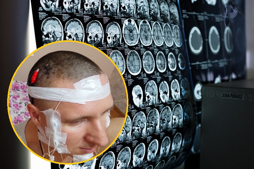 Przewiercił sobie głowę wiertarką. 40-latek z Rosji cudem przeżył