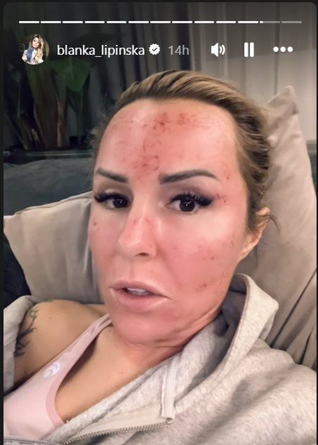 Blanka Lipińska z posiniaczoną twarzą po "tajemniczym zabiegu".