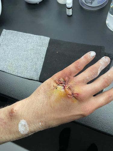 Tak wyglądała dłoń po założeniu szwów / Oskar Polis Racing