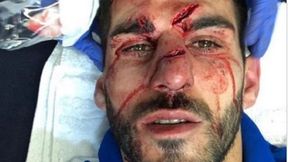 Rywal nadepnął mu na twarz. Nelson Oliveira: Mogłem stracić wzrok