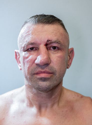 Na zdjęciu: twarz Tomasza Adamka po walce (fot. Fame MMA)