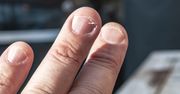 Groźny niedobór. Zdradza go wygląd naszych paznokci
