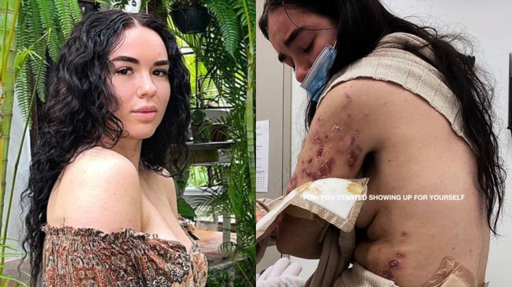 23-latka zapisała się na zabieg odchudzający. Jej ciało zaczęło gnić